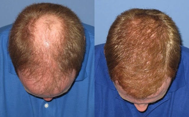 Hair Transplant Financing: Options for Managing the Cost
